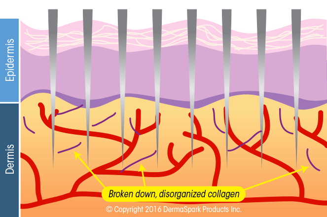 1-micro-needling