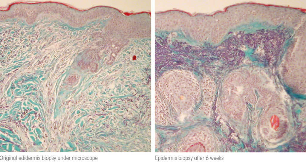 Collagen biopsy