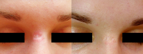 skin treatment 50 over DermaSpark Dermaroller Micro   Needling Products Inc.