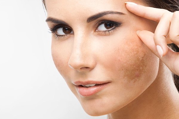 melasma and dark spots