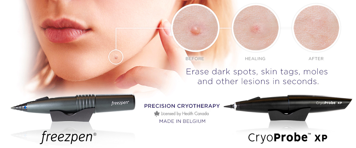 Freezpen et CryoProbe