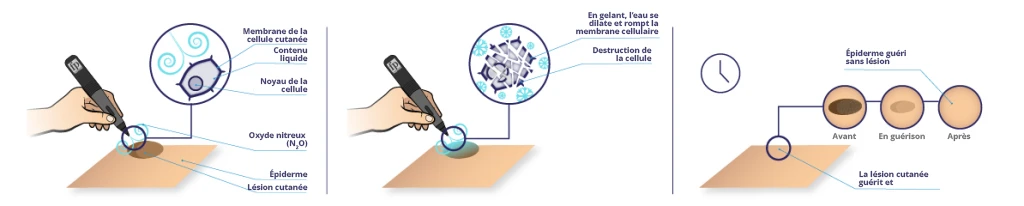 How Freezpen & CryoProbe XP Work Comment fonctionnent le Freezpen et le CryoProbe XP
