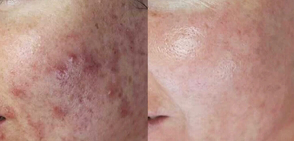 Dermalux LED Phototherapy