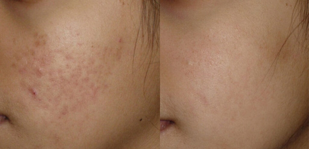 Dermaroller Microneedling
