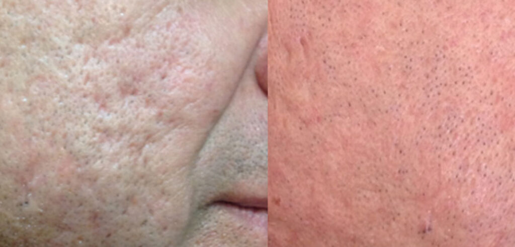 Dermaroller Microneedling