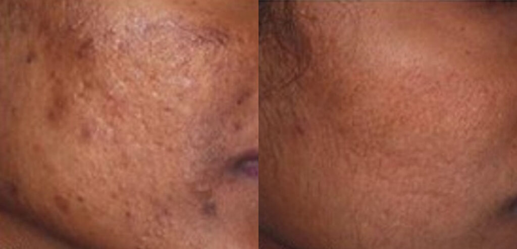 Dermaroller Microneedling