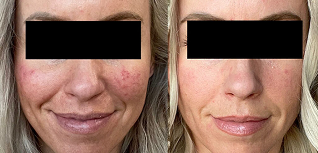 Divine Pro — Non-Surgical Facelift