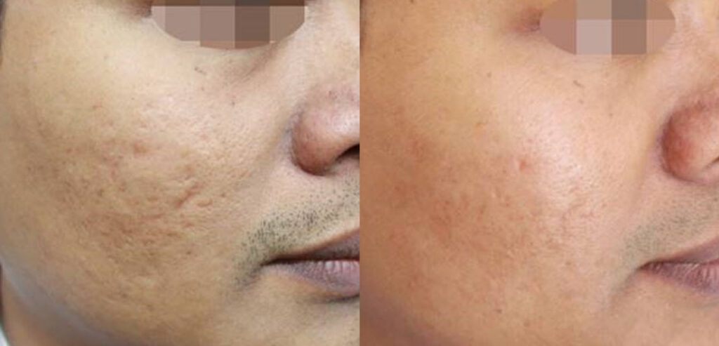 Divine Pro — Non-Surgical Facelift