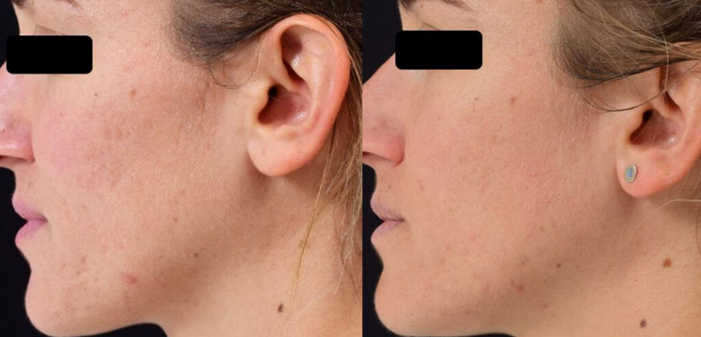 Divine Pro — Non-Surgical Facelift