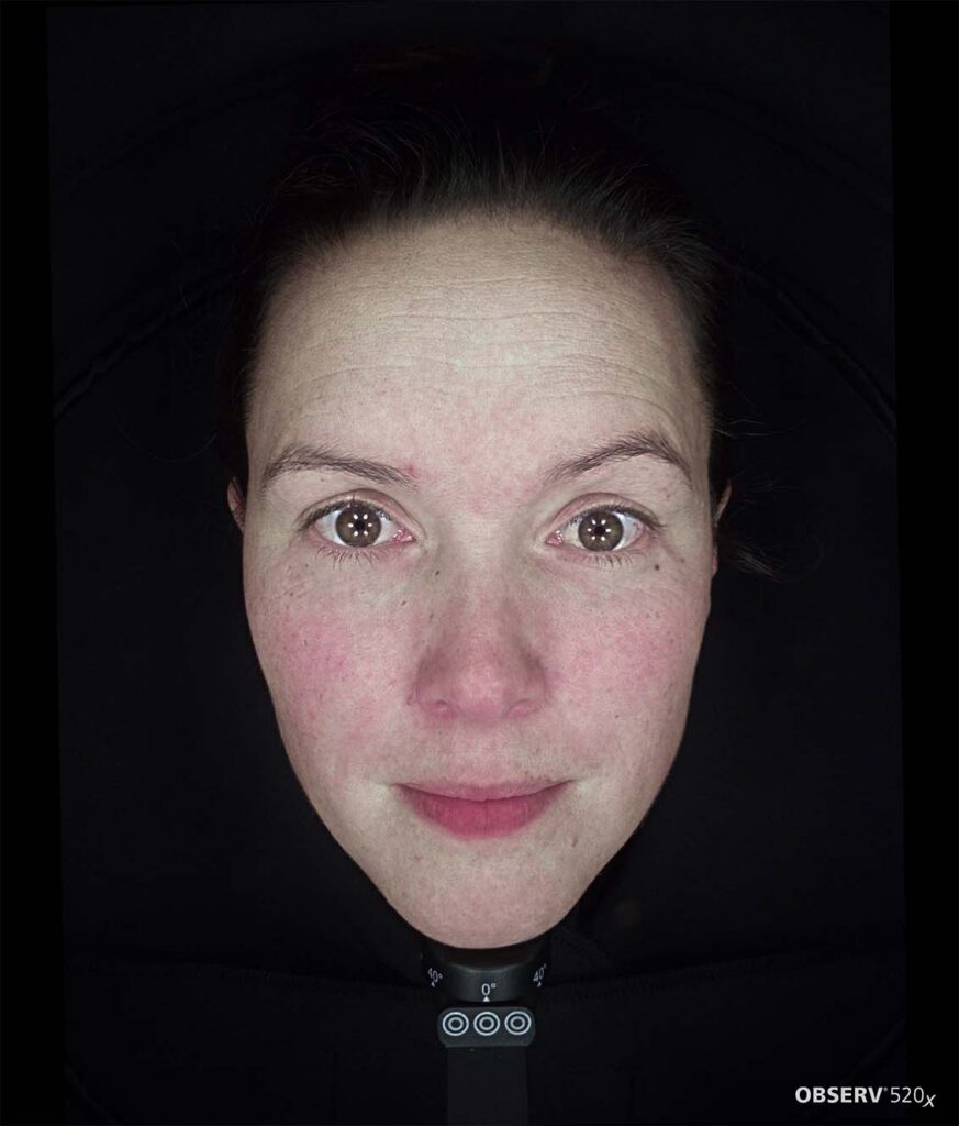 OBSERV — Professional Skin Analysis