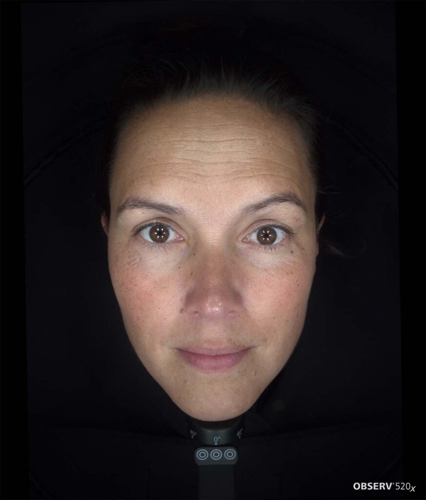 OBSERV — Professional Skin Analysis