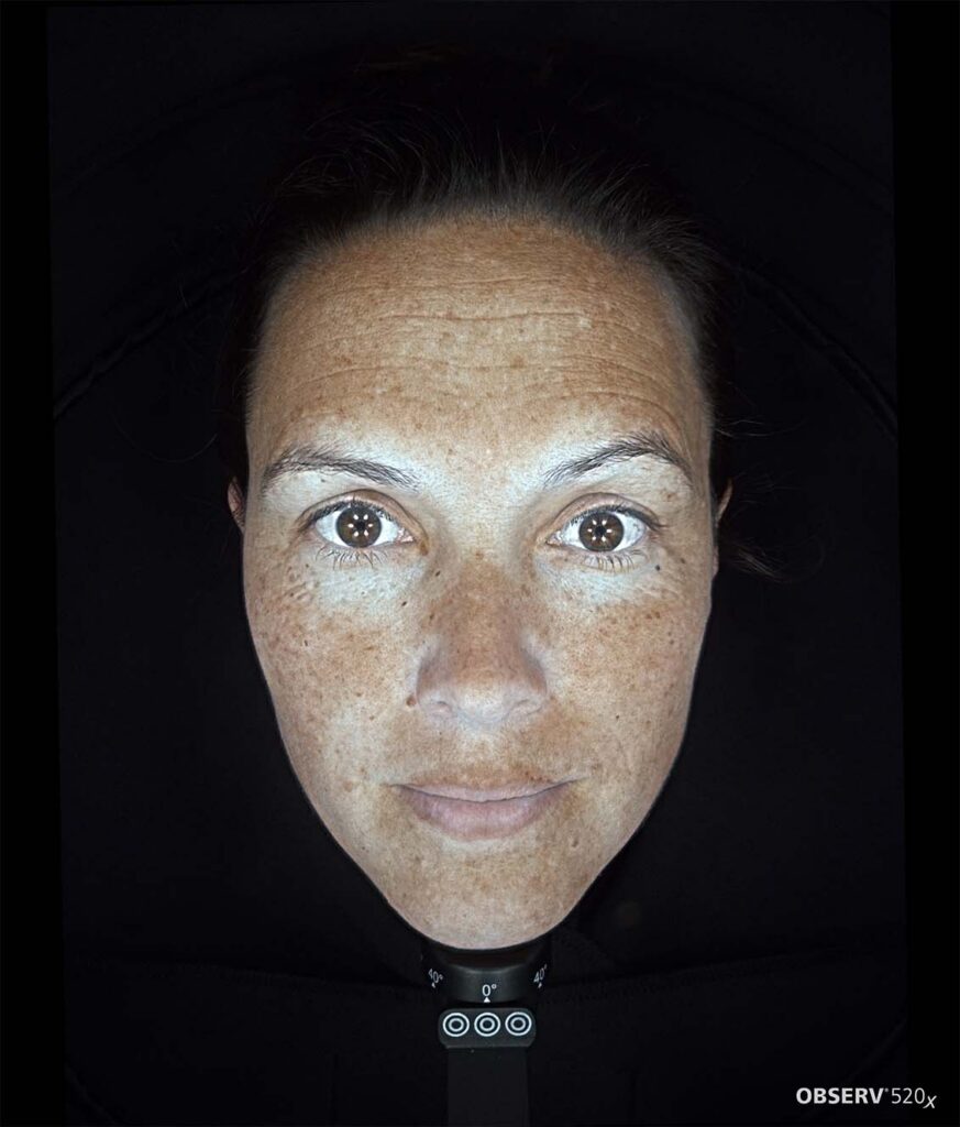 OBSERV — Professional Skin Analysis