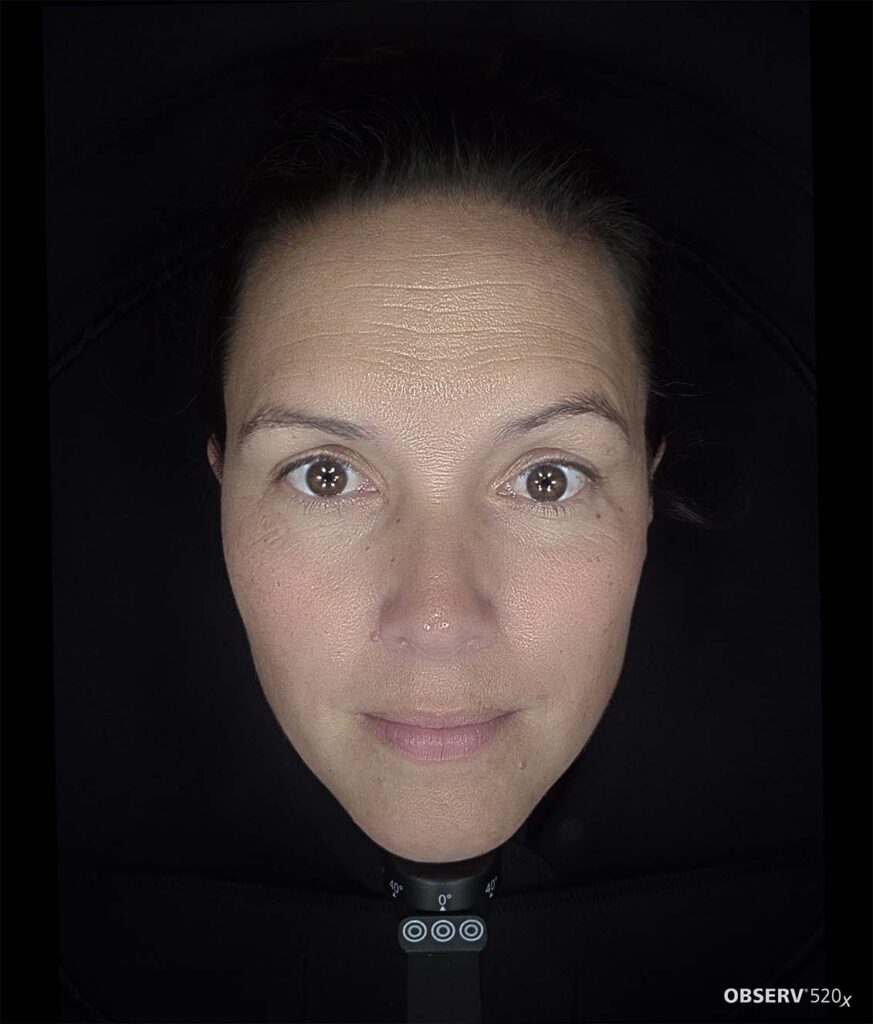 OBSERV — Professional Skin Analysis