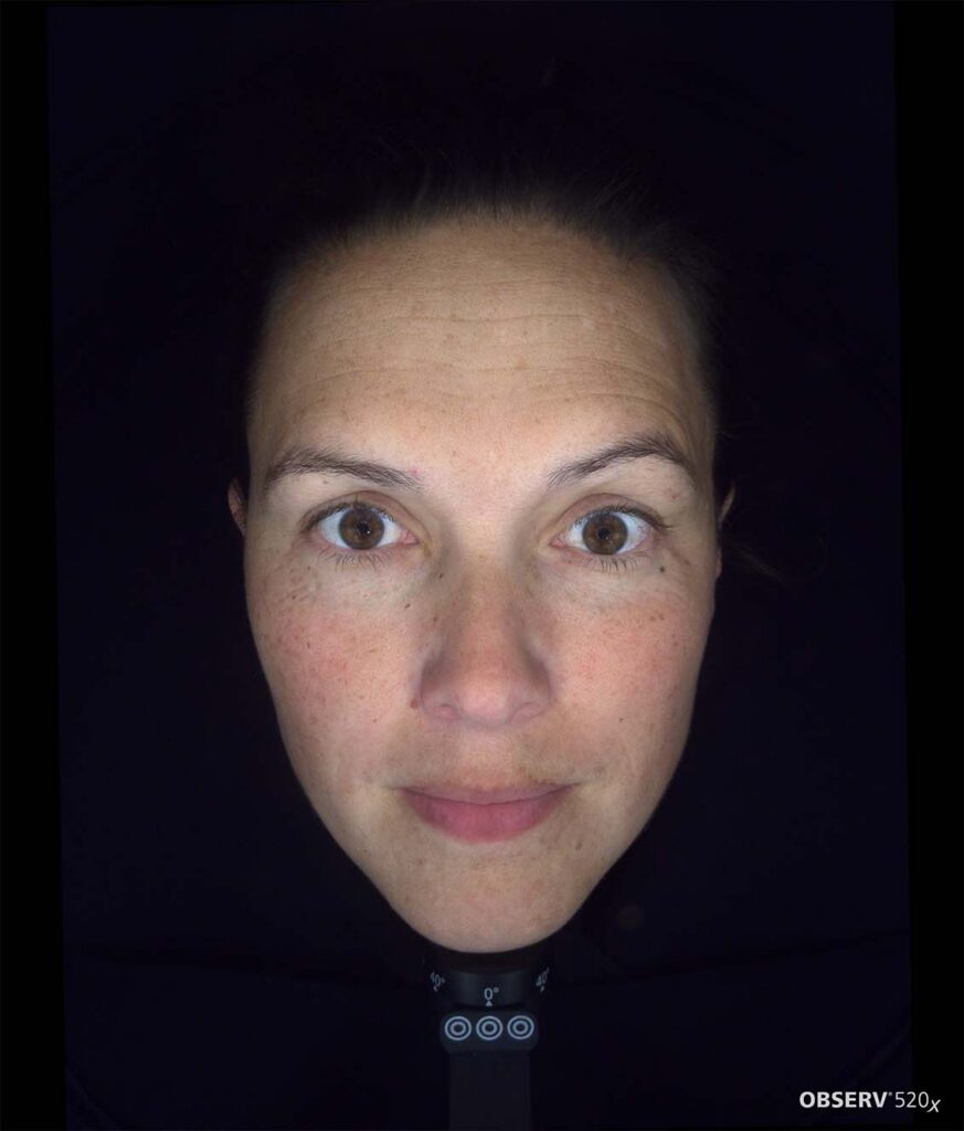 OBSERV — Professional Skin Analysis
