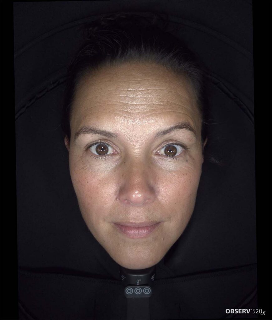 OBSERV — Professional Skin Analysis