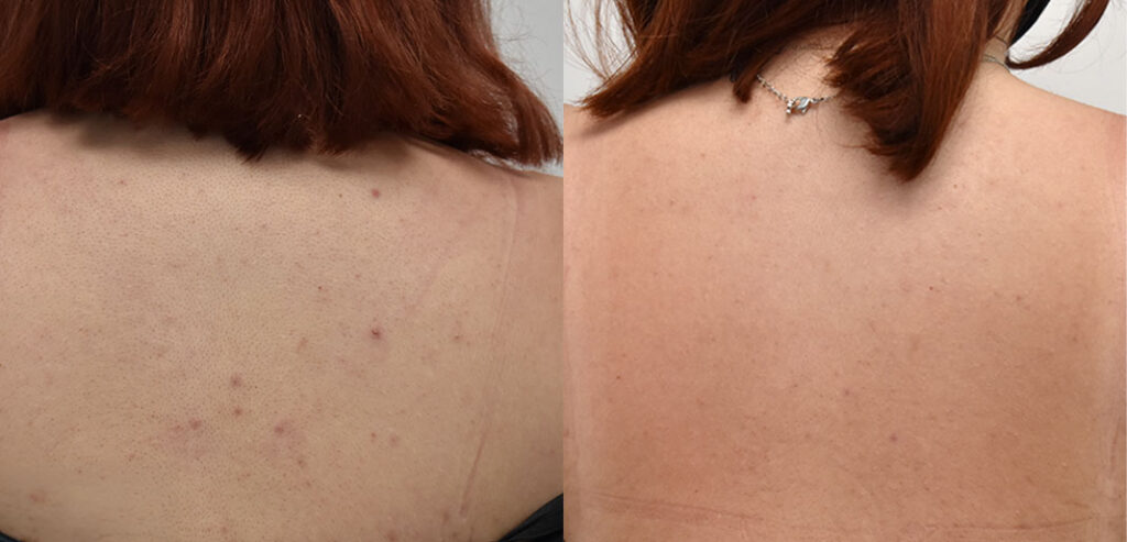 OxyGeneo Super Facial
