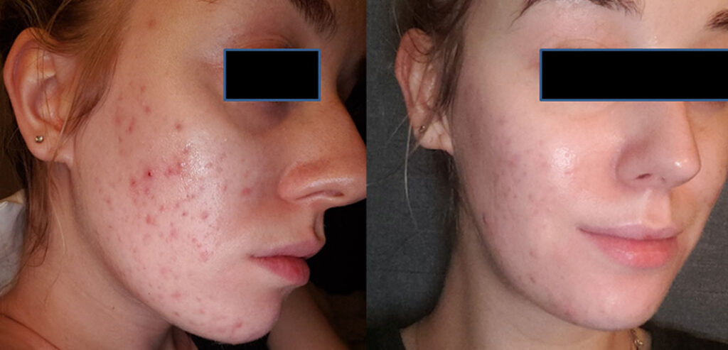 OxyGeneo Super Facial