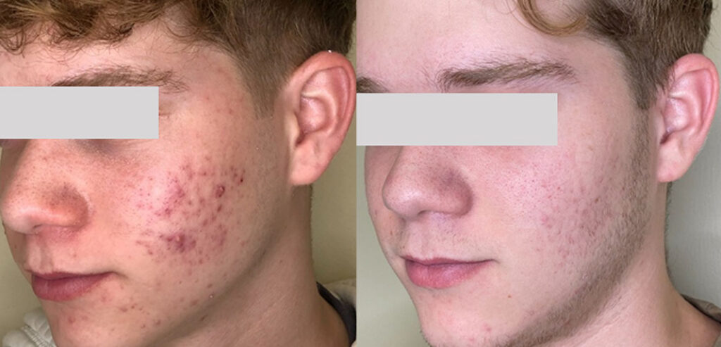 Alpha Laser — Hair Removal & Photorejuvenation