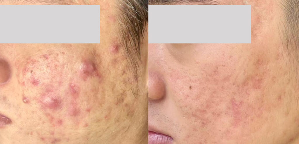 Alpha Laser — Hair Removal & Photorejuvenation