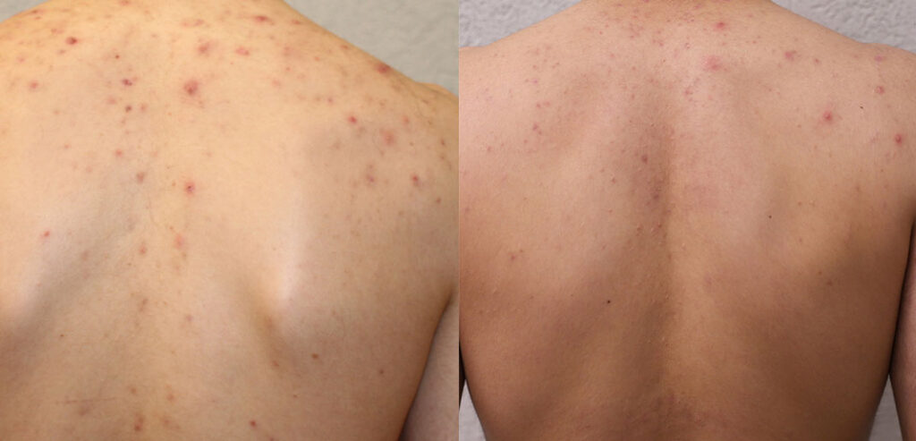 Alpha Laser — Hair Removal & Photorejuvenation