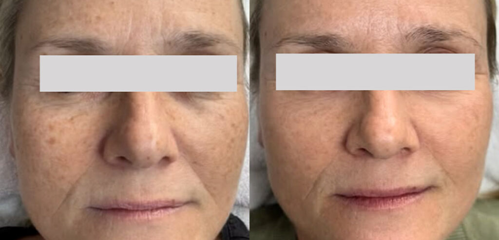 Alpha Laser — Hair Removal & Photorejuvenation