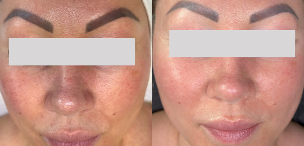 Alpha Laser — Hair Removal & Photorejuvenation
