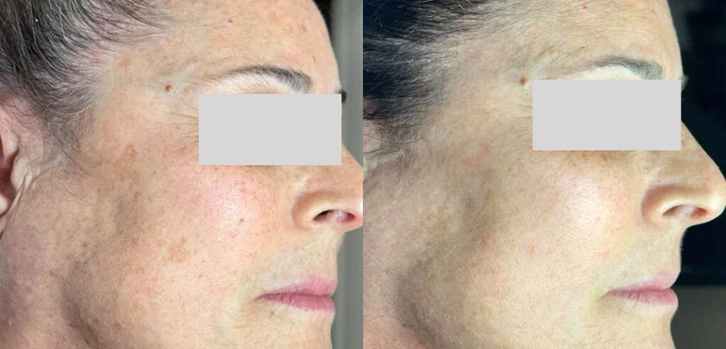 Alpha Laser — Hair Removal & Photorejuvenation