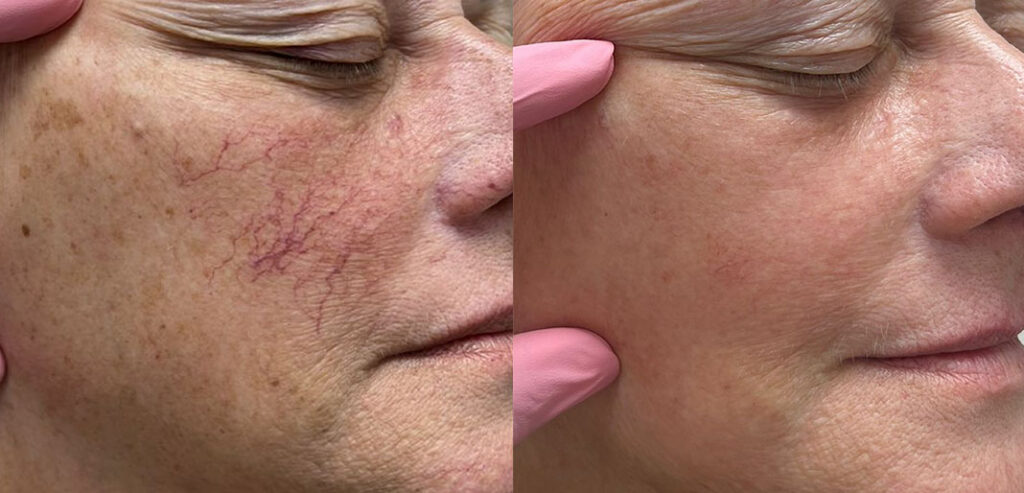 Alpha Laser — Hair Removal & Photorejuvenation