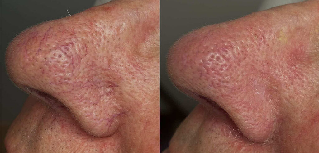 Alpha Laser — Hair Removal & Photorejuvenation