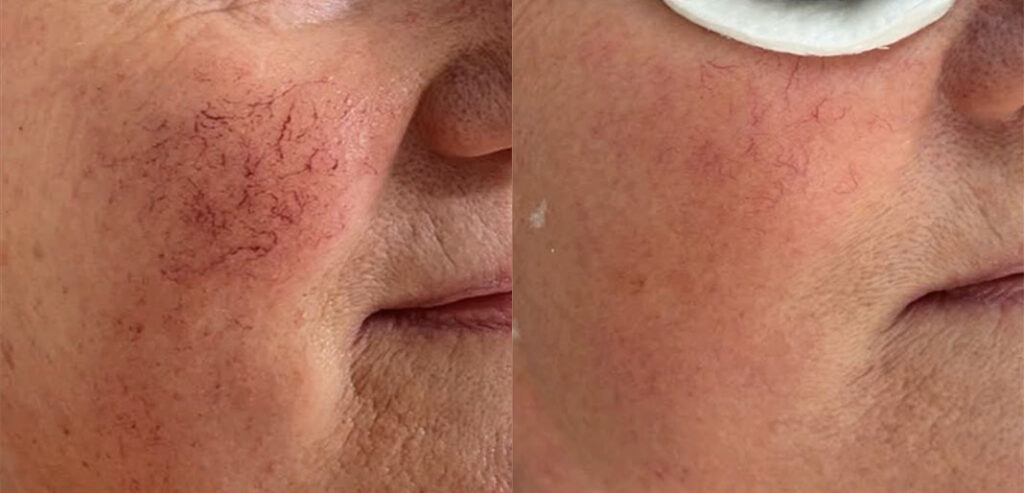Alpha Laser — Hair Removal & Photorejuvenation