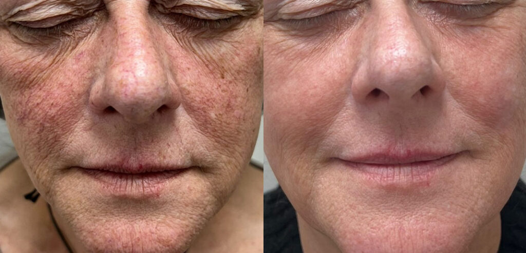 Alpha Laser — Hair Removal & Photorejuvenation