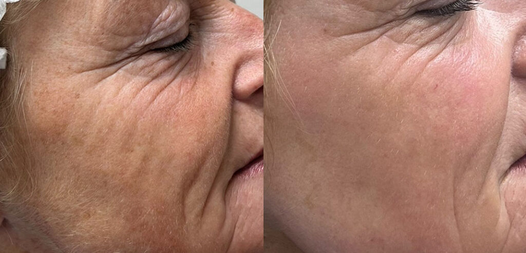 Alpha Laser — Hair Removal & Photorejuvenation