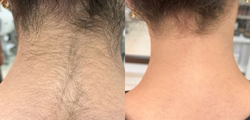 Alpha Laser — Hair Removal & Photorejuvenation