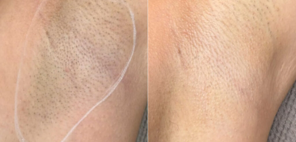 Alpha Laser — Hair Removal & Photorejuvenation