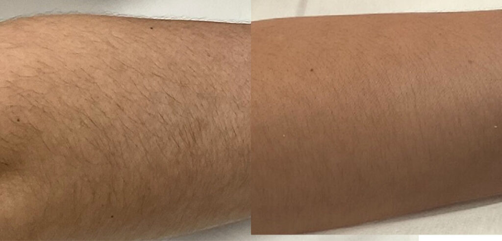 Alpha Laser — Hair Removal & Photorejuvenation
