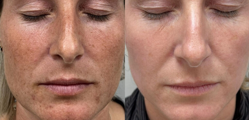 Alpha Laser — Hair Removal & Photorejuvenation