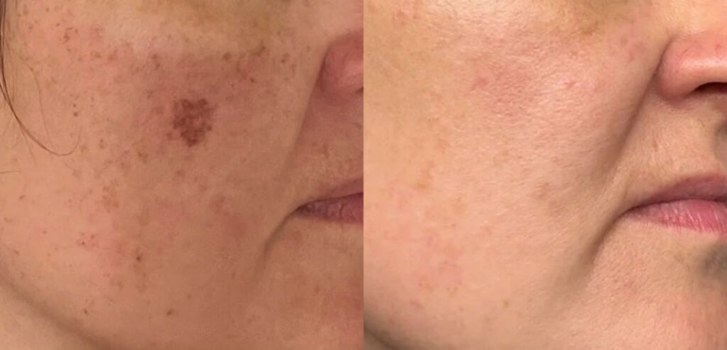 Alpha Laser — Hair Removal & Photorejuvenation