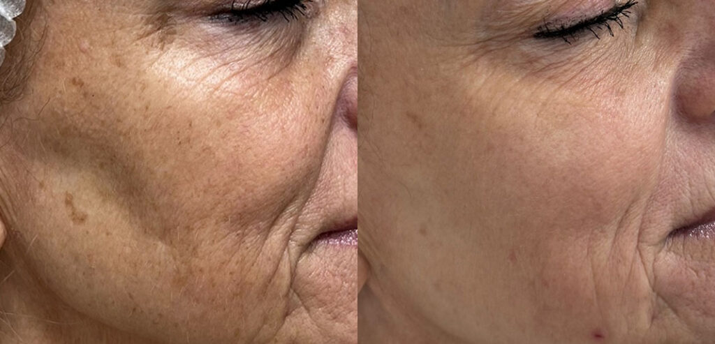 Alpha Laser — Hair Removal & Photorejuvenation