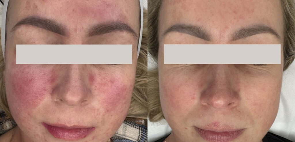 Alpha Laser — Hair Removal & Photorejuvenation