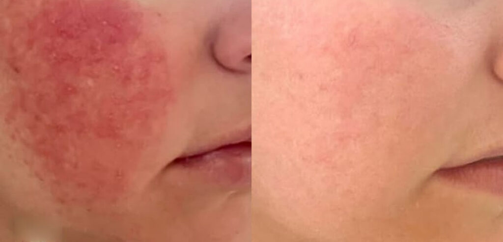 Alpha Laser — Hair Removal & Photorejuvenation