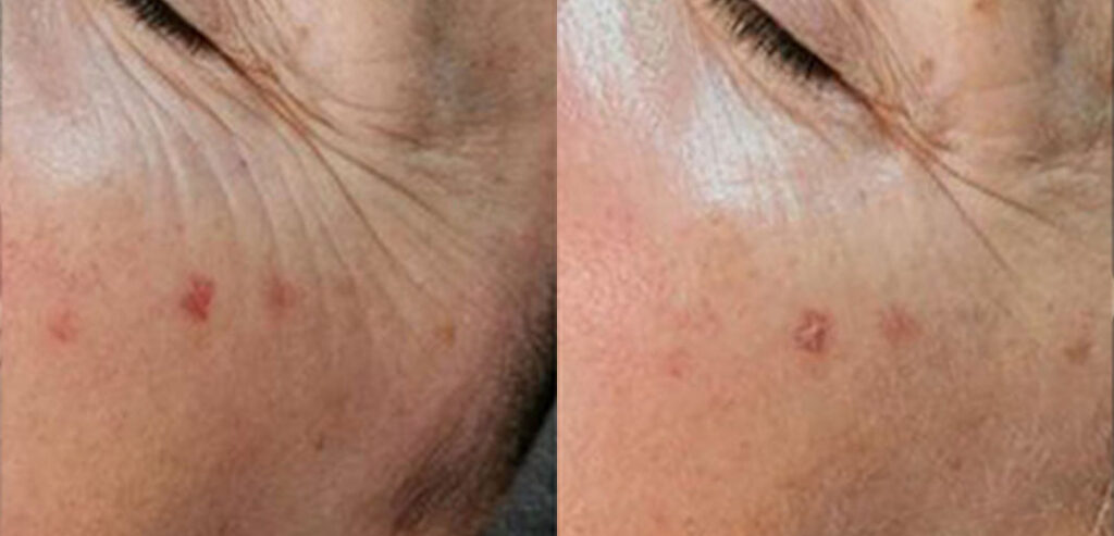 Dermalux LED Phototherapy