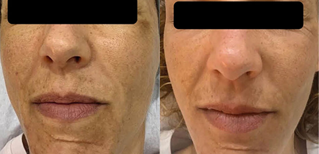 Dermalux LED Phototherapy