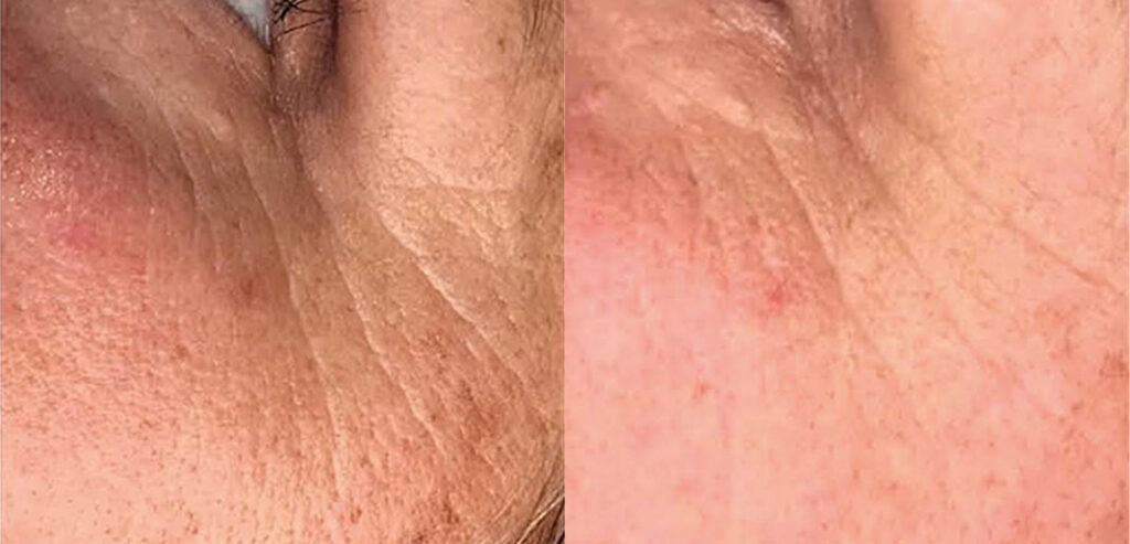 Dermalux LED Phototherapy