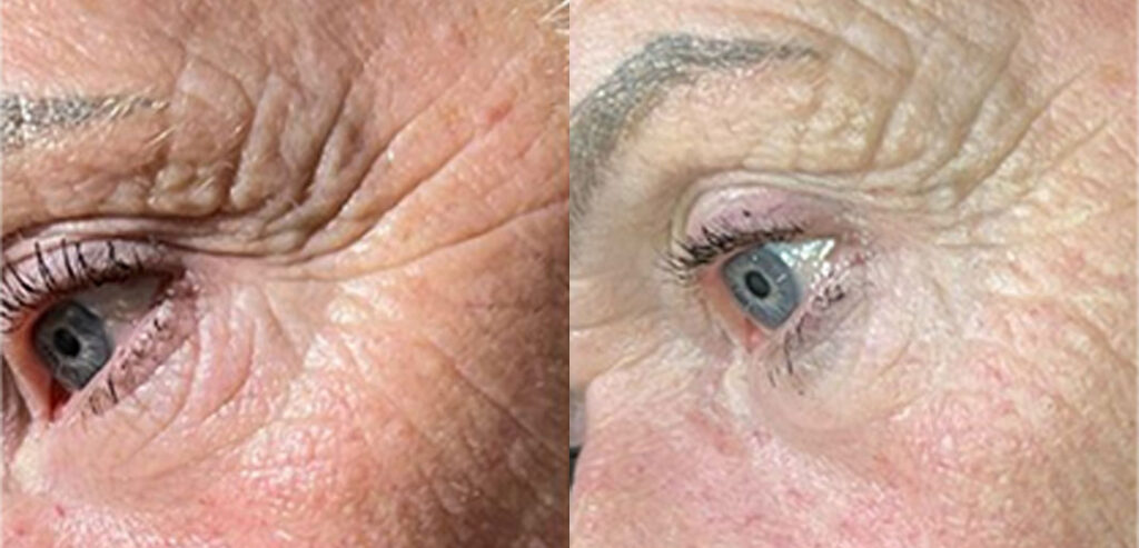 Dermalux LED Phototherapy