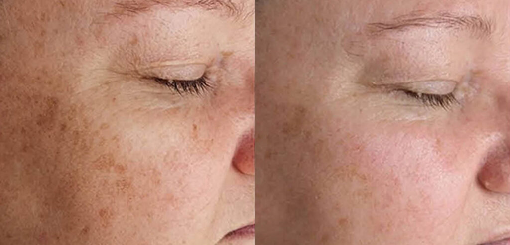 Dermalux LED Phototherapy