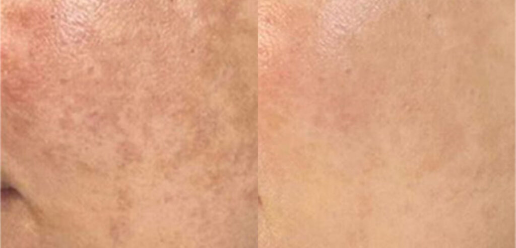 Dermalux LED Phototherapy