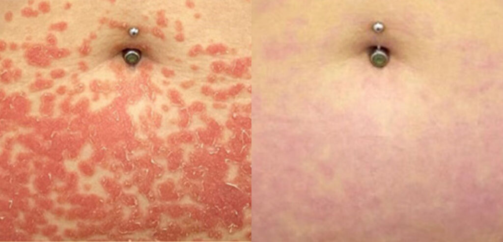 Dermalux LED Phototherapy