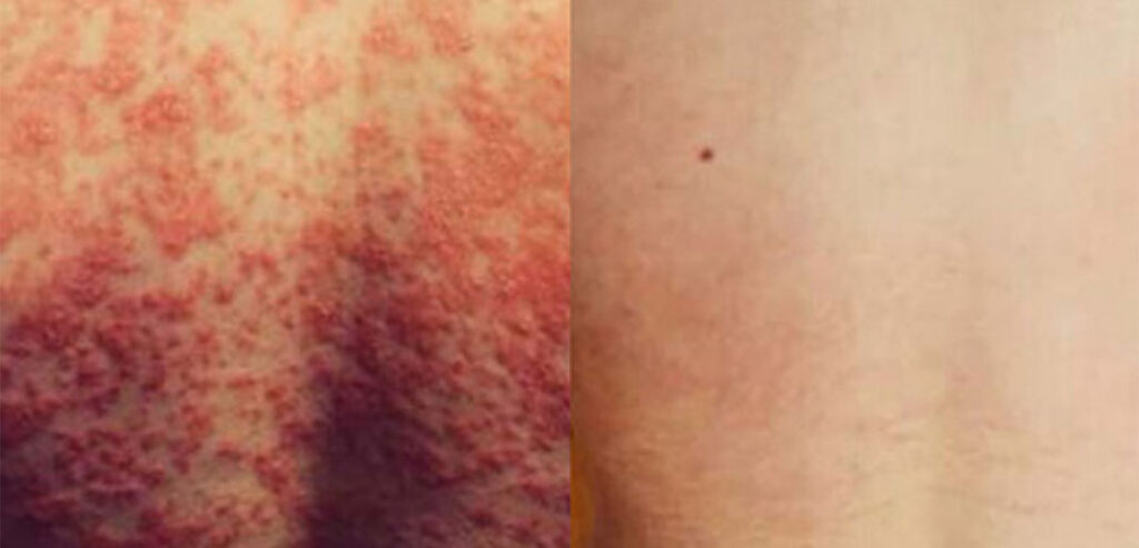 Dermalux LED Phototherapy