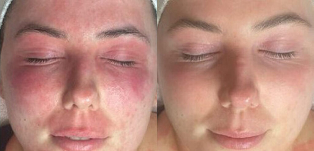 Dermalux LED Phototherapy