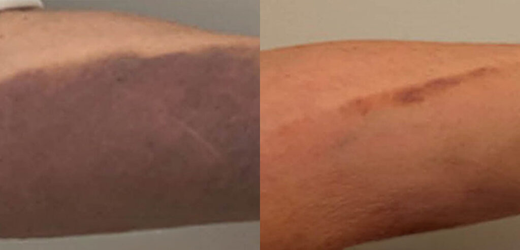 Dermalux LED Phototherapy